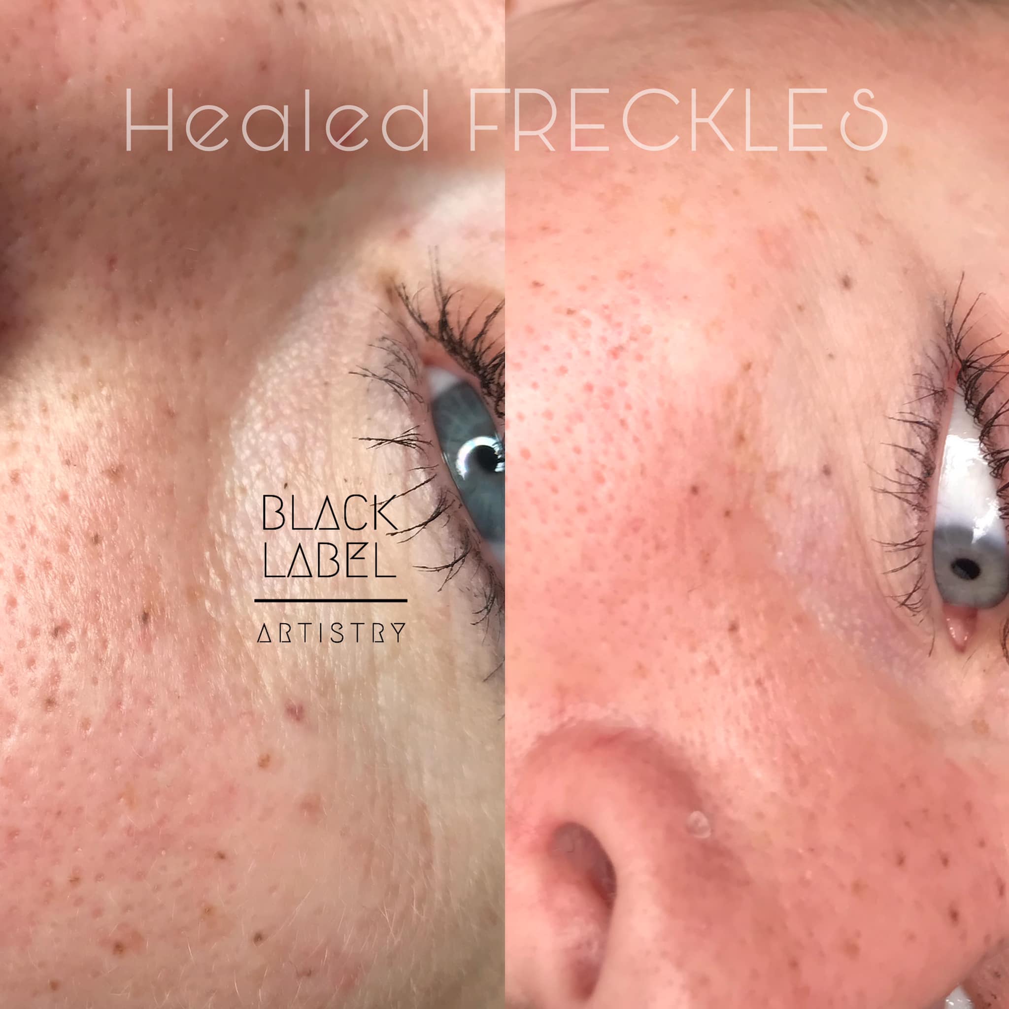 Permanent makeup freckles