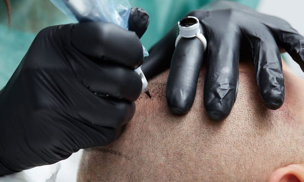 Scalp micropigmentation in action