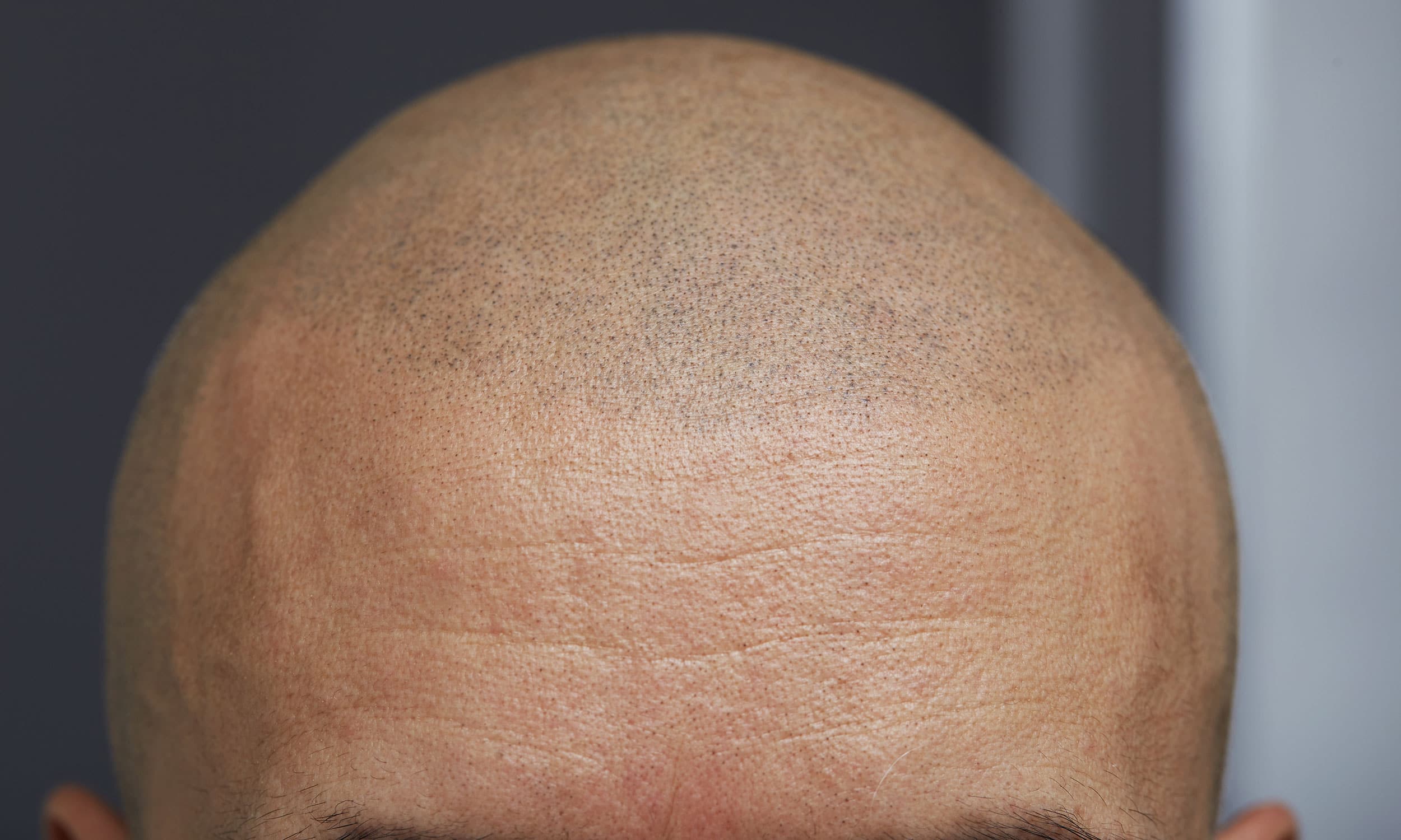 Scalp micropigmentation