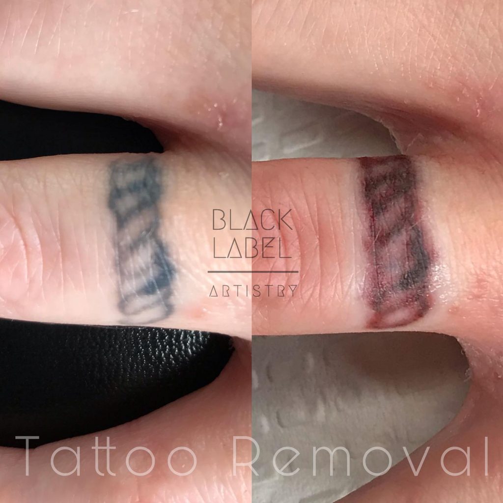 tattoo-removal