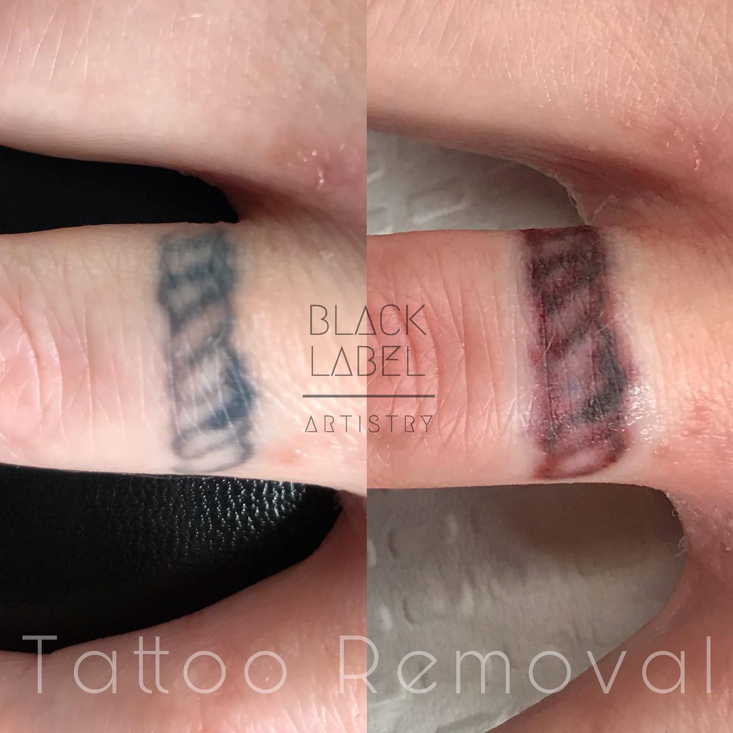 tattoo-removal