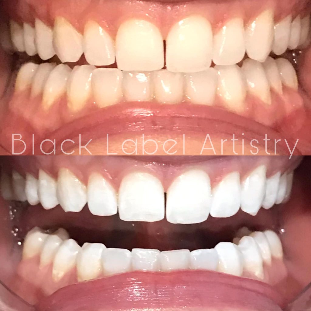 teeth whitening kentucky