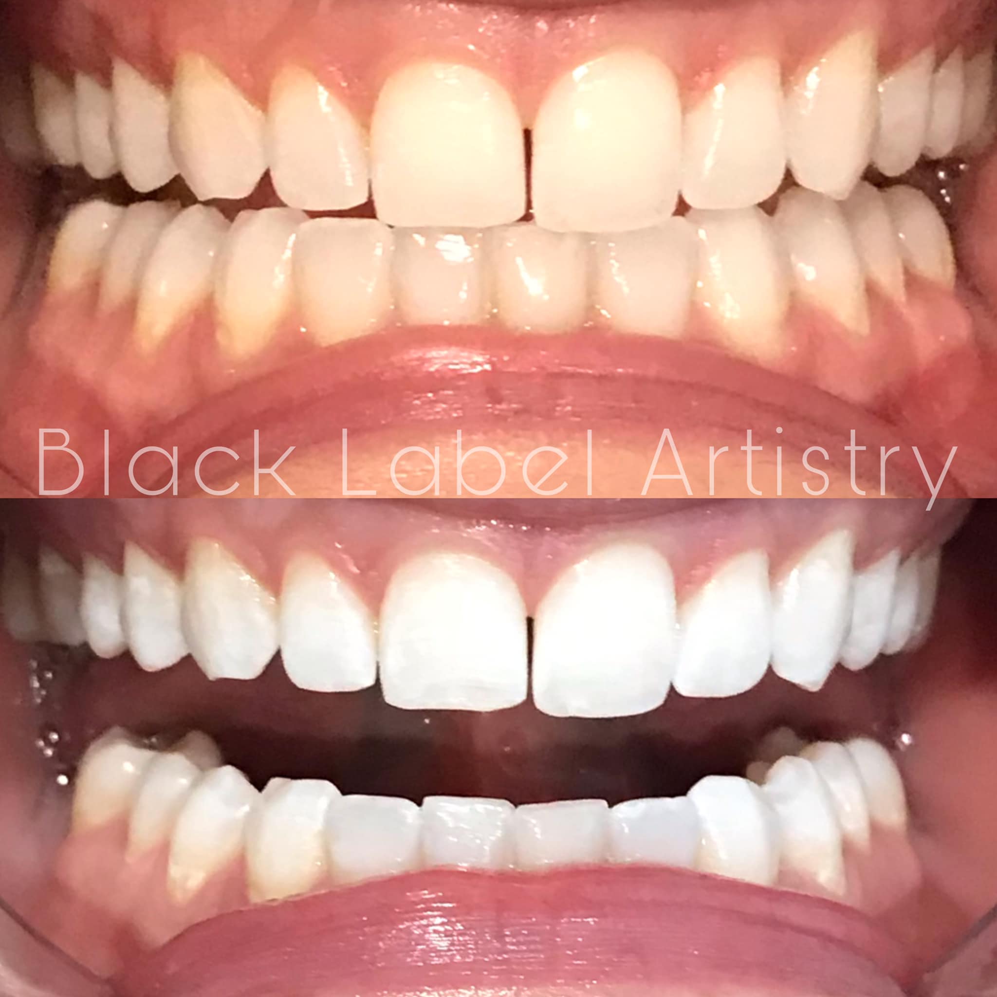 teeth whitening kentucky